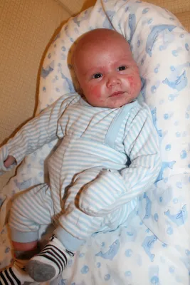Это акне новорожденных или что-то другое? — 5 ответов | форум Babyblog