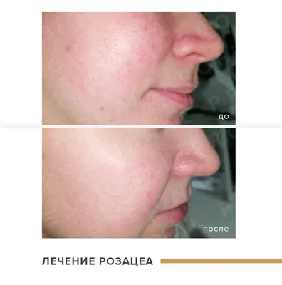 Розацеа как отличить от акне и периорального дерматита | DermaQuest | Дзен