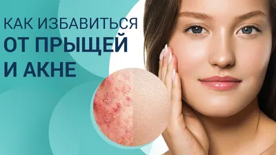 Лечение розацеа | MediSPA центр BIOSFERA