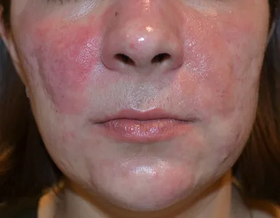 Косметолог Нью-Йорк - ⠀ ☝️Розацеа (от лат. acne rosacea — розовые угри) —  это хроническое заболевание кожи лица, вызываемое ангионевротическими  нарушениями. ⠀ Основные признаки и симптомы розацеа: ⠀ 😡 Стойкое  покраснение кожи