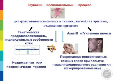 Современные подходы к терапии угревой болезни – тема научной статьи по  клинической медицине читайте бесплатно текст научно-исследовательской  работы в электронной библиотеке КиберЛенинка