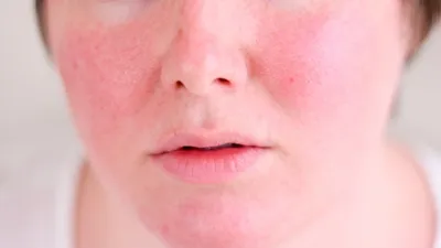 АКНЕ (аcne vulgaris) — запальне захворювання шкіри, причиною якого є  обструкція і запалення пілосебацейного комплексу (волосяних фолікулів… |  Instagram