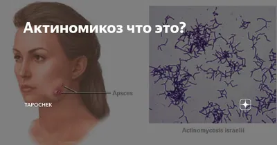 АКТИНОМИКОЗ (ACTINOMYCOSIS)