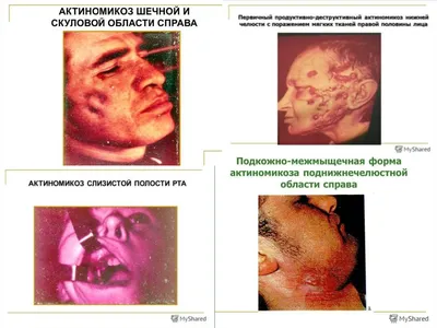 Лечение грибковых заболеваний в Нижнем Новгороде | Клиника Доверие