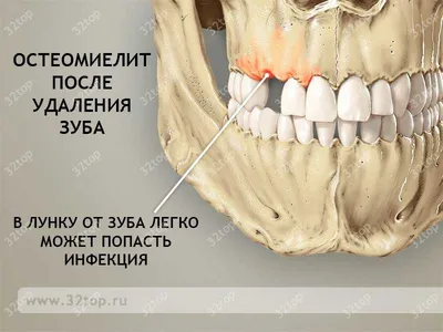 Мик. Актиномикоз. + | Портал радиологов