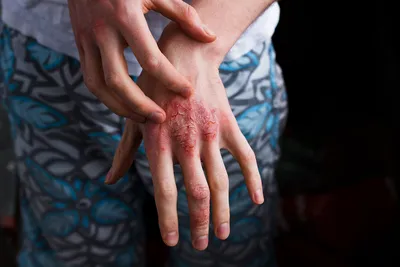 Контактный аллергический дерматит | Казахстанская Ассоциация  дерматовенерологов