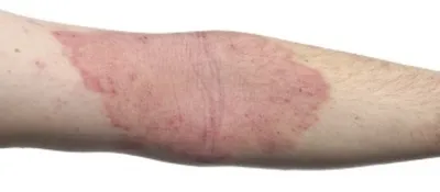 закрытая рука женщины, чешущая кожу. аллергическая сыпь дерматит экзема  кожа насекомые аллергия на продукты Стоковое Фото - изображение  насчитывающей рука, людск: 274839780