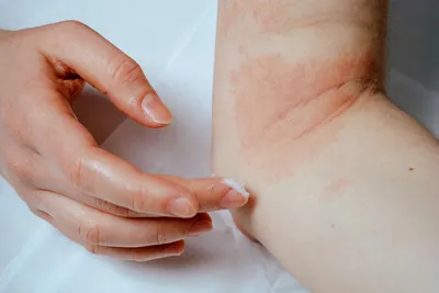 Аллергия, дерматит, экзема 📍Первый признак аллергии на руках это отсутсвие  рогового лоскута - кутикулы. А также сухая и ломкая пластина, … | Instagram