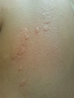 Сыпь на коже, крапивница, аллергическая реакция кожи Стоковое Изображение -  изображение насчитывающей аллергически, преданности: 93000601