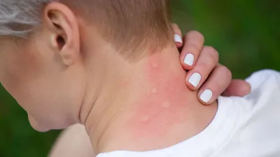 Аллергия на холод и на жару: симптомы этой крапивницы и методы лечения