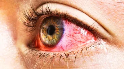 Аллергическая Реакция На Глаз — стоковые фотографии и другие картинки  Воспалённый глаз - Воспалённый глаз, Пипетка - Лекарство, Аллергия - iStock
