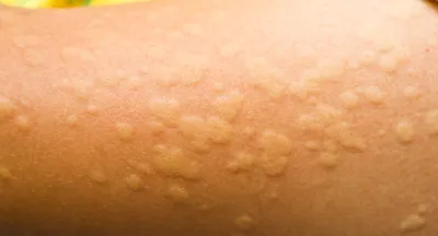Аллергия на казеин: симптомы на doc.ua