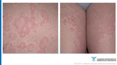 Холодовая аллергия. Что это и как ухаживать за кожей. - блог Cleo Line