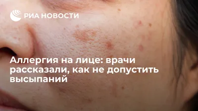 Аллергия на лице у взрослых и детей: что делать и чем лечить сыпь на коже