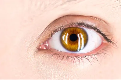 Аллергические отеки под глазами - как снять быстро