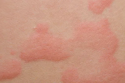 Аллергические высыпания на коже фото фото