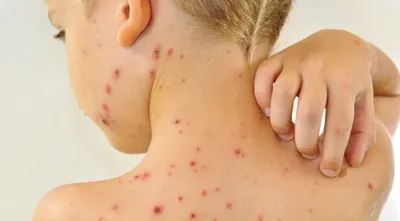 Заболевания кожи у детей - Детская поликлиника Маркушка