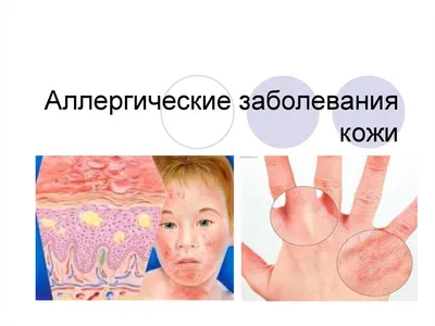 Аллергические заболевания кожи - презентация онлайн