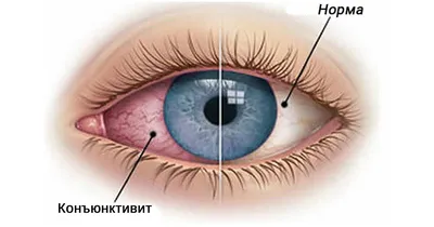 Аллергический конъюнктивит у детей и взрослых. Симптомы и лечение