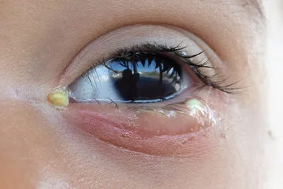 Врач-офтальмолог из Турции - КОНЪЮНКТИВИТ 🌀Конъюнктивит — это воспаление  слизистой оболочки, которая покрывает наружную поверхность глазных яблок и  прилегающую поверхность век. ❗️Заболевание может иметь различный характер:  вирусный, бактериальный ...