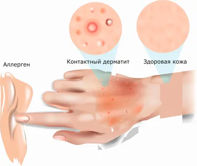 Аллергический контактный дерматит на пыльцу растений - Клиника доктора  Блашенцева