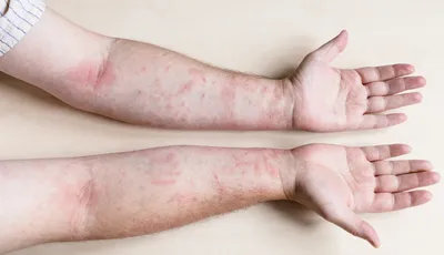 Аллергический дерматит контакта на голени Стоковое Изображение -  изображение насчитывающей зудяще, экзема: 151755093