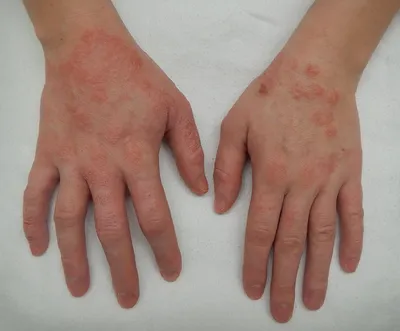 Аллергический дерматит: стадии, виды, симптомы, причины, лечение