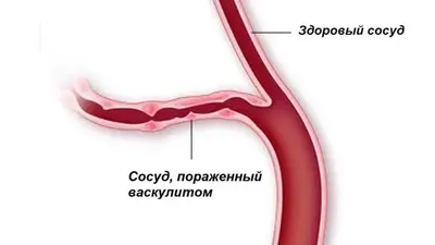 Больной Эпифоликулит Кожи С Сыпью — стоковые фотографии и другие картинки Аллергический  васкулит - Аллергический васкулит, Аллергия, Болезни кожи - iStock