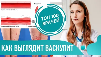 тромбоцитопатия или аллергический васкулит? Форум Страница 1