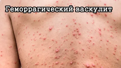 Аллергический васкулит - причины, симптомы, лечение — Fenkarol® средство от  аллергии