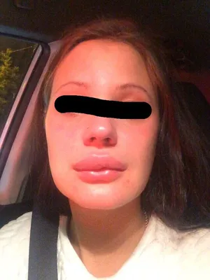 Аллергия на ботокс фото фото