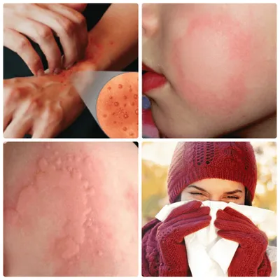 Аллергия на ботокс. Последствия будут беспощадны! | Красота и уход | Дзен