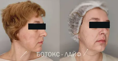 Инъекции ботокса: цена в Москве | Стоимость уколов ботокса от морщин в  клинике BeautyWay Clinic