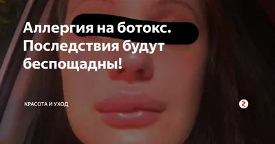 Актриса Полина Максимова раскрыла подробности страшной аллергии на лице