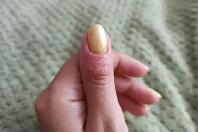 Аллергия на гель для наращивания ногтей фото фото