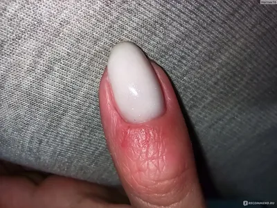 Аллергия на гель лак на ногтях: как проявляется
