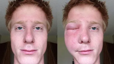 Аллергия на глазах отек фото фото