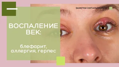 Более 60% россиян ежегодно сталкиваются с симптомами аллергии - ТАСС