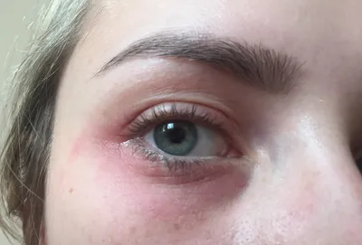 Аллергия в области глаз: варианты реакций | МедИнфо | Дзен