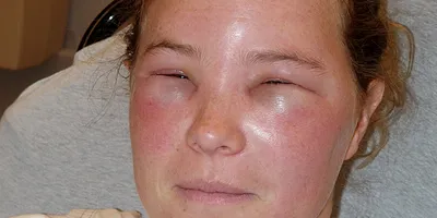 Специалисты рассказали, как аллергия влияет на здоровье глаз - МК