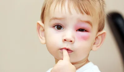 Аллергический отек век у ребенка - энциклопедия Ochkov.net