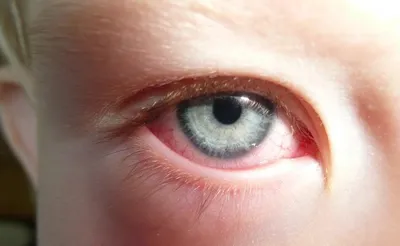 Аллергия на глазах у ребенка - фото, лечение, причины и симптомы