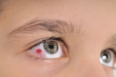 Аллергия на глазах у ребенка фото фото