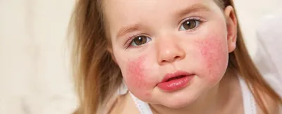 Что делать, если у ребёнка аллергия? — Медицинский центр «Целитель»