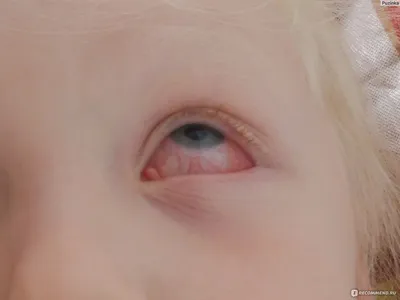 Красный глаз у грудничка - лечение, причины