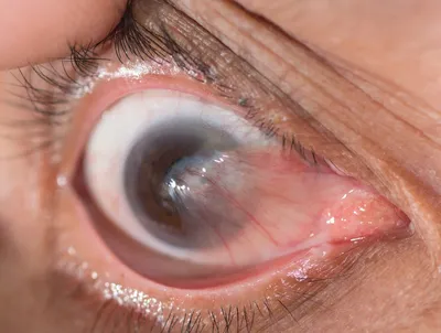 Темные круги под глазами - причины появления, симптомы заболевания,  диагностика и способы лечения