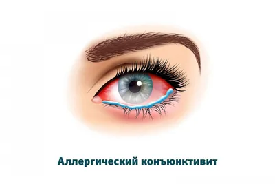 Покраснение глаз после душа: причины и лечение – ГКДБ