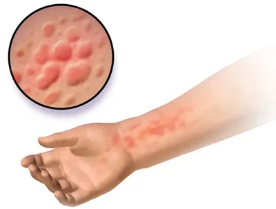 Можно ли мыться при аллергии на коже: советы и рекомендации