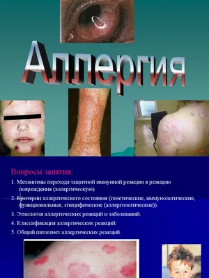аллергия | PDF