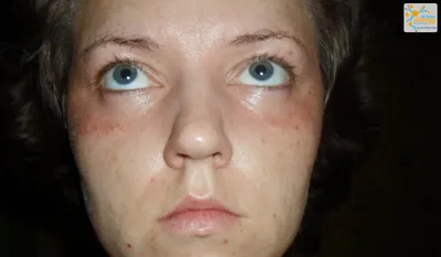 аллергия на косметику. девушка смотрит на прыщи вокруг глаз, которые  появились после использования токсичной косметики. красные пя Стоковое Фото  - изображение насчитывающей сторона, она: 248186856